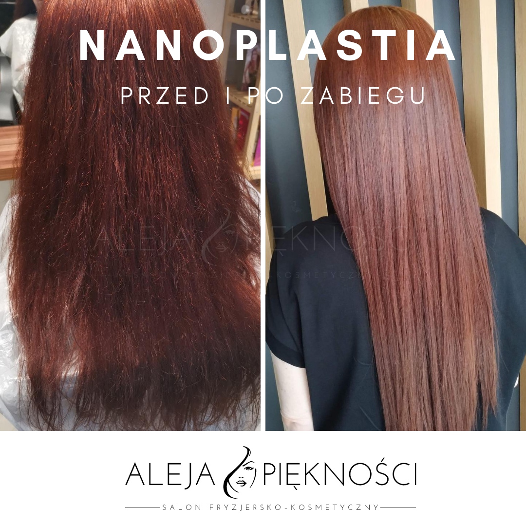 Nanoplastyka bialystok przed i po efekt